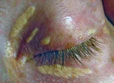 Xanthelasma can be a symptom of high cholesterol